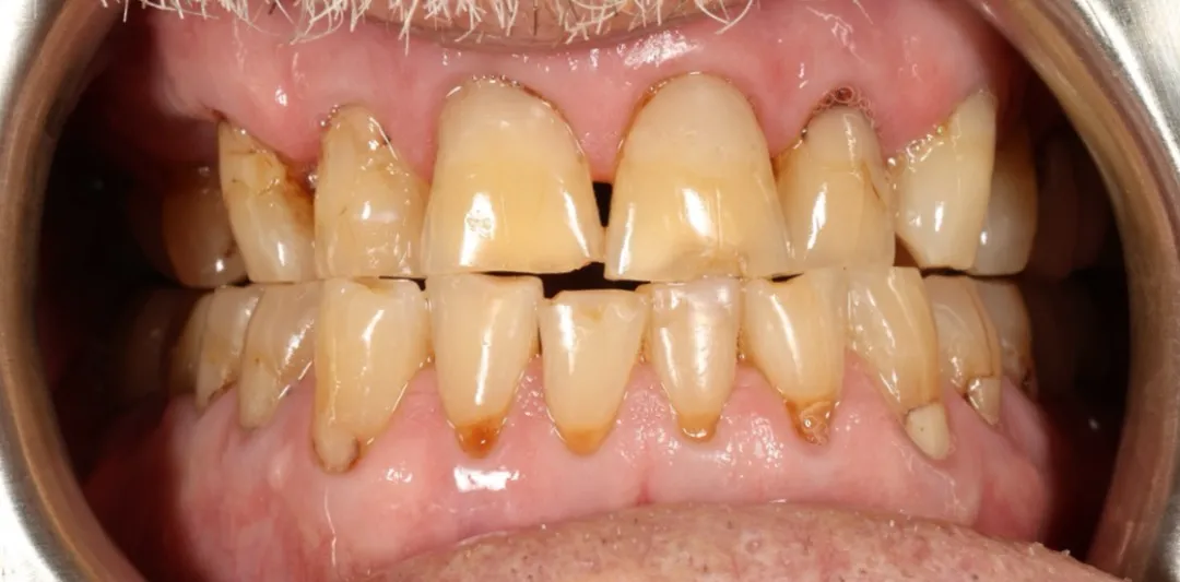 Before and after teeth restoration using biocompatible materials in biological dentistry in Florida.