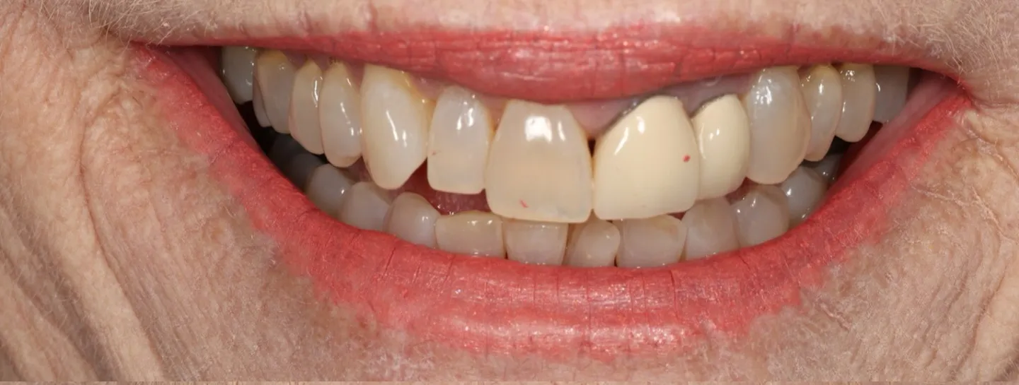 Before and after cosmetic teeth enhancement using biological dentistry techniques in Florida.