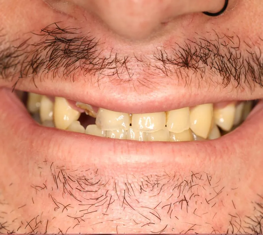 Before and after teeth restoration by a biological dentist in Florida using holistic dental techniques.